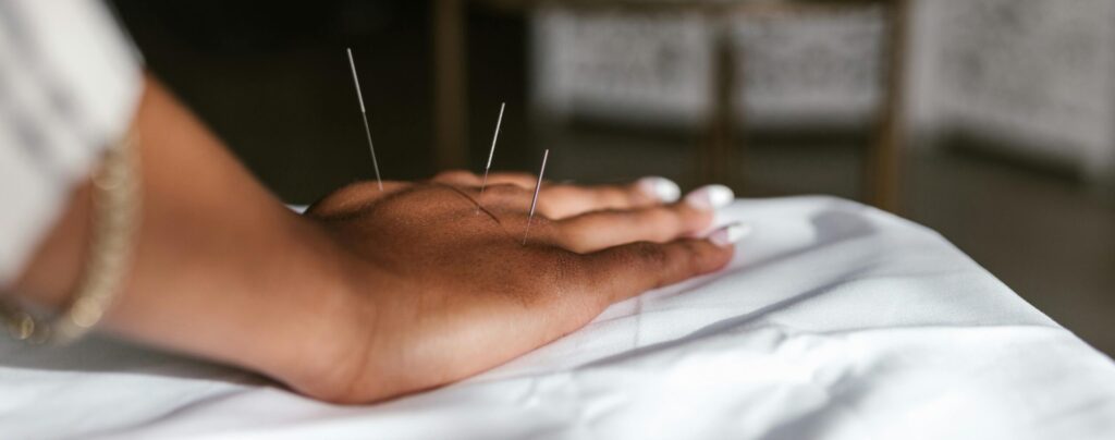 Alt text: A close-up of a hand resting on a white surface with acupuncture needles inserted into it, representing a therapy session related to Friday Health.