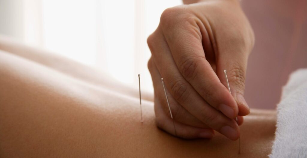 A person receiving acupuncture treatment, with a focus on the hand placing a needle on the skin, representing Friday Health.